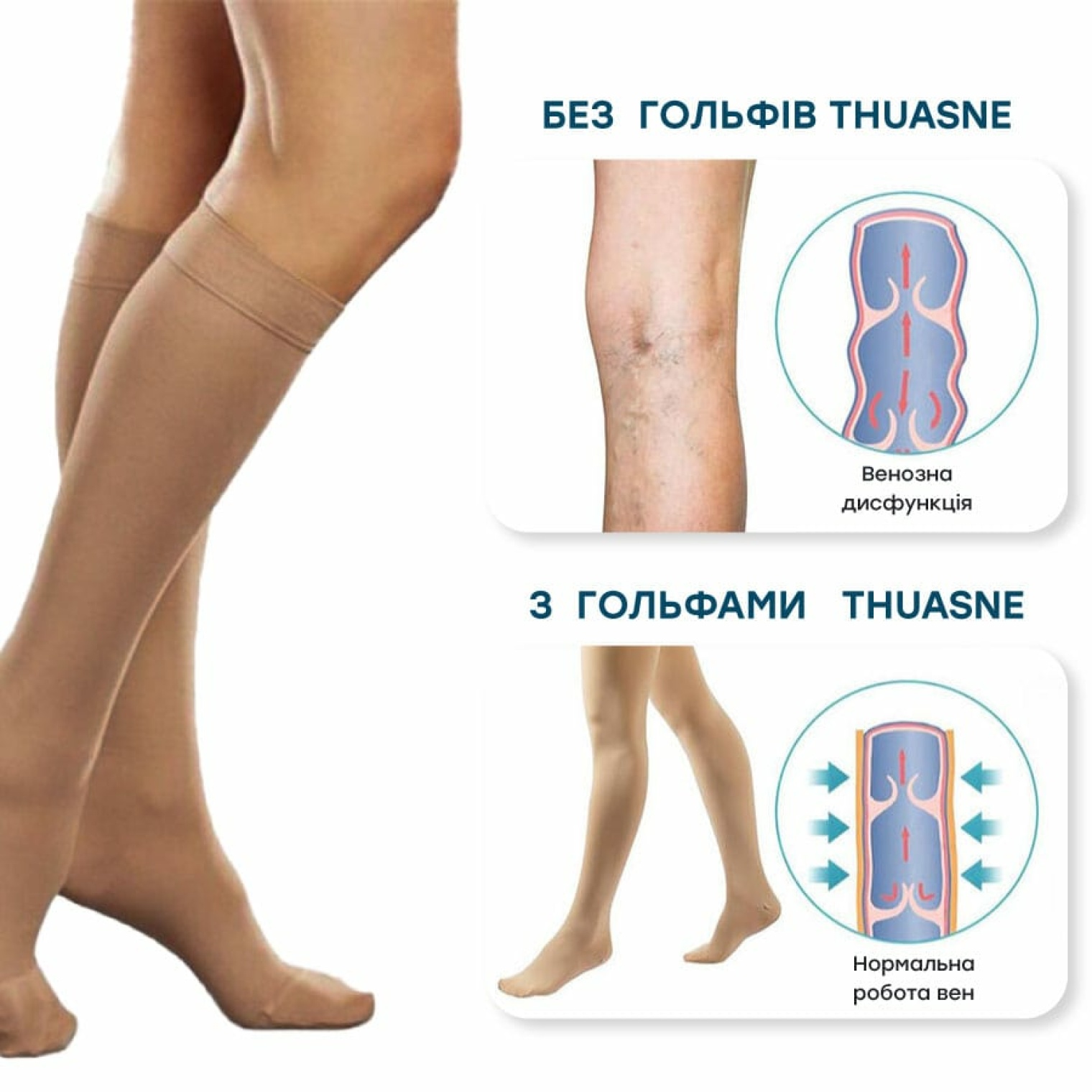 Профилактика варикозного расширения вен